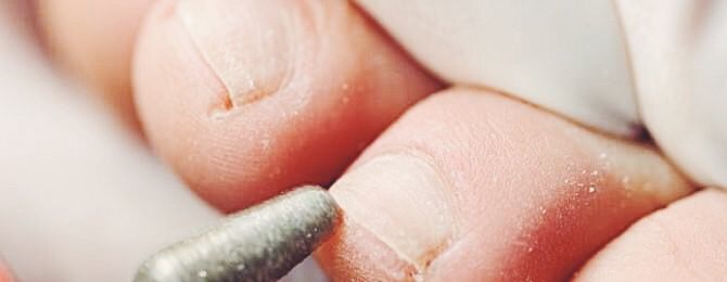 Leczenie wrastających paznokci